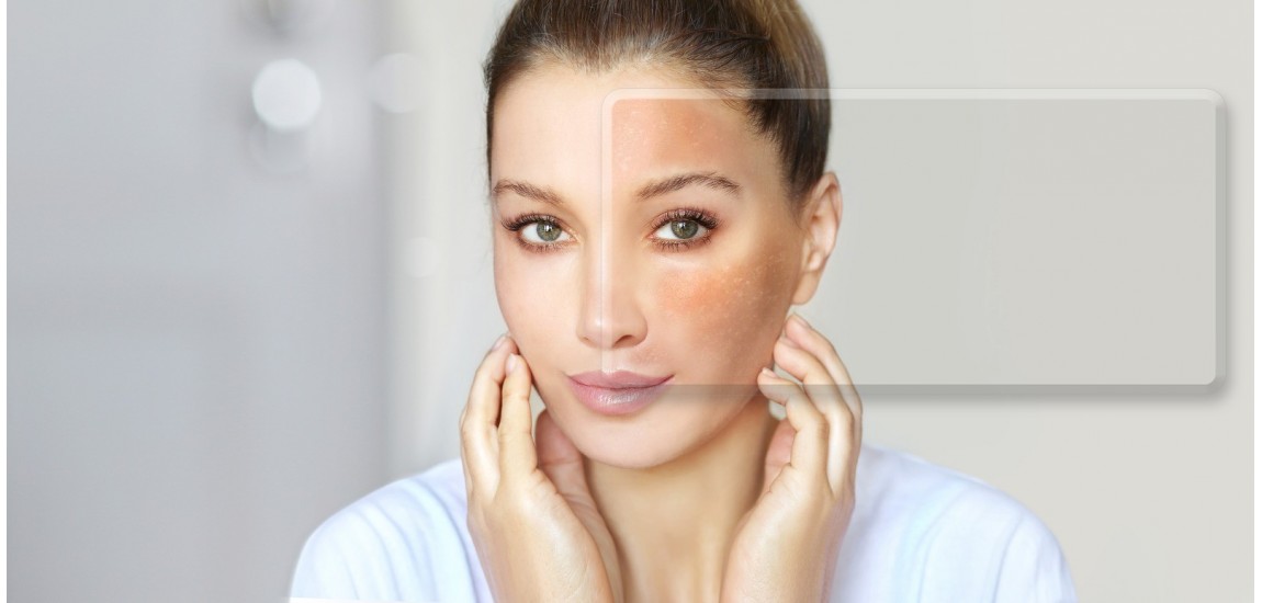 Melasma: todo lo que debes saber
