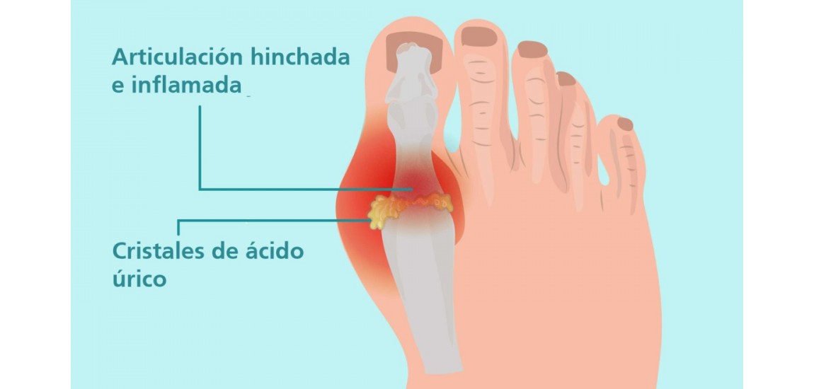 ¿Por qué debes controlar el Ácido Úrico?